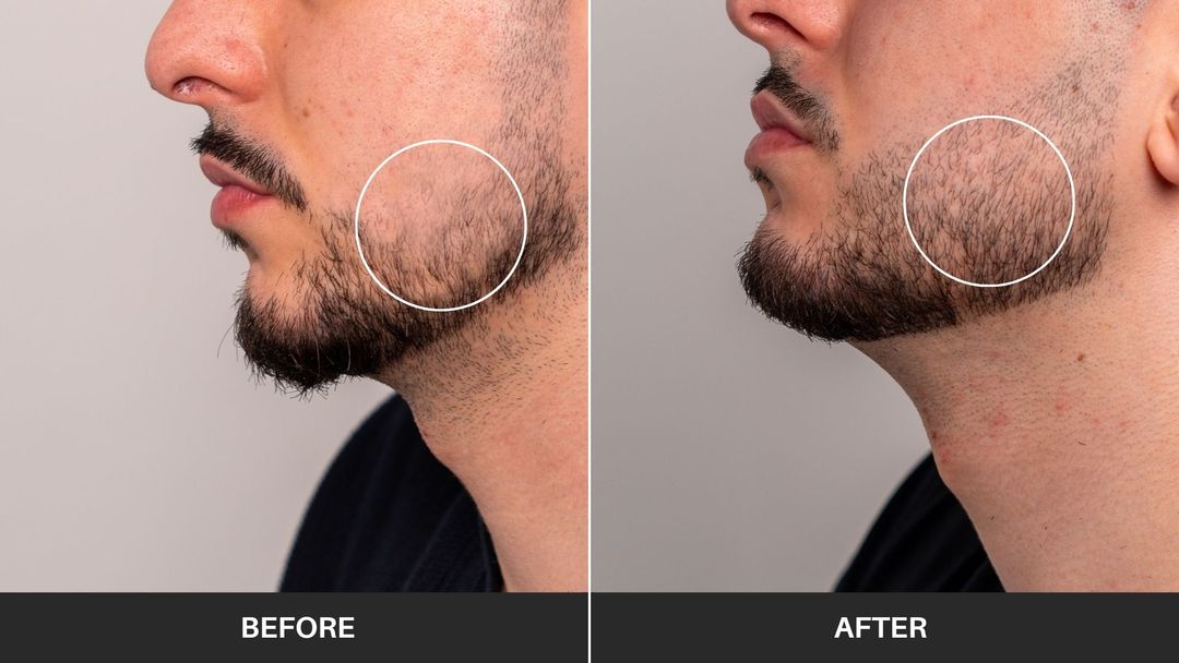 Before and after fixing patchy beard with Odenson Kit